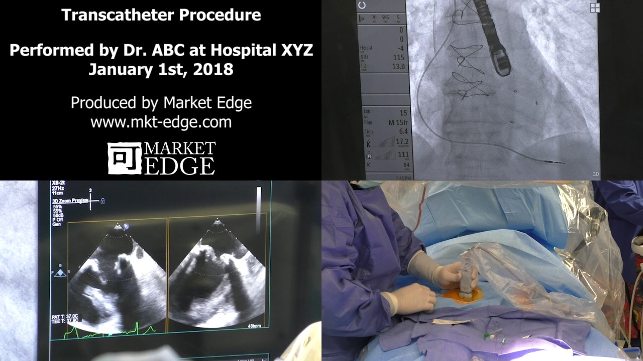 Healthcare Market Research Public Transcather Video Sample Screenshot v2 2 - Healthcare Market Research